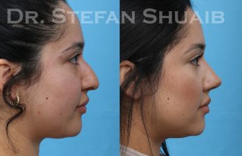 patient before and after rhinoplasty