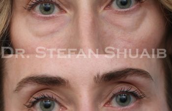 patient before and after blepharoplasty