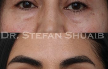 patient before and after blepharoplasty