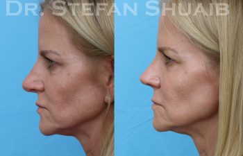 patient before and after rhinoplasty