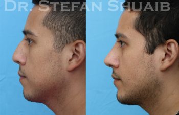 patient before and after rhinoplasty