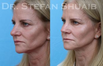 patient before and after rhinoplasty