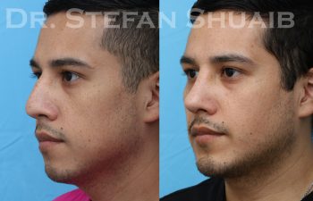 patient before and after rhinoplasty