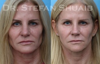 patient before and after rhinoplasty