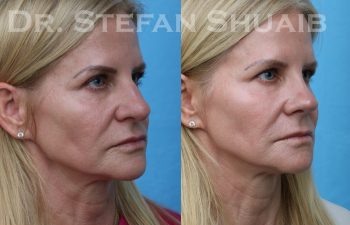 patient before and after rhinoplasty