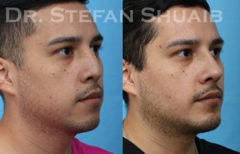 patient before and after rhinoplasty