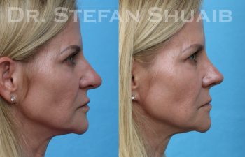 patient before and after rhinoplasty