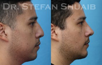 patient before and after rhinoplasty