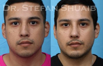 patient before and after rhinoplasty