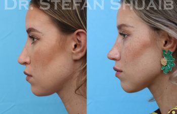 patient before and after rhinoplasty