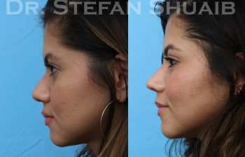 patient before and after asian rhinoplasty