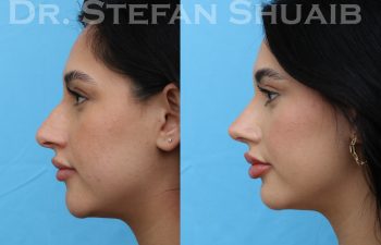 patient before and after rhinoplasty