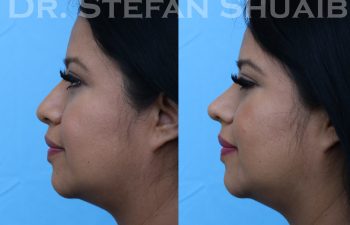 patient before and after rhinoplasty