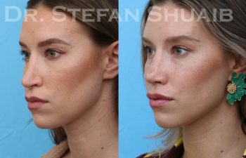 patient before and after rhinoplasty