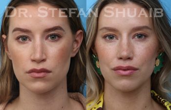 patient before and after rhinoplasty