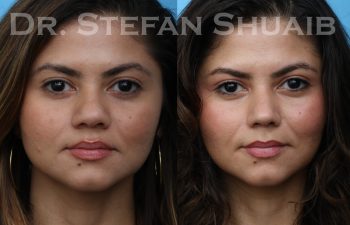 patient before and after asian rhinoplasty