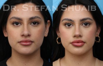 patient before and after rhinoplasty