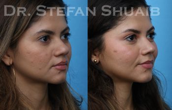 patient before and after asian rhinoplasty