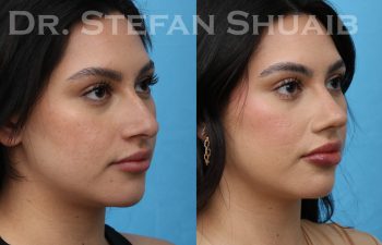 patient before and after rhinoplasty