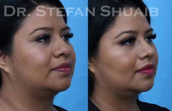 patient before and after rhinoplasty