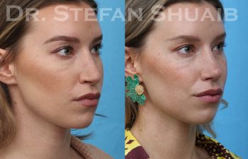 patient before and after rhinoplasty