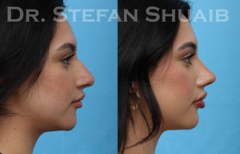 patient before and after rhinoplasty