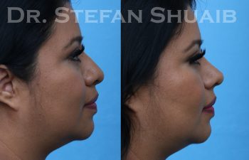 patient before and after rhinoplasty