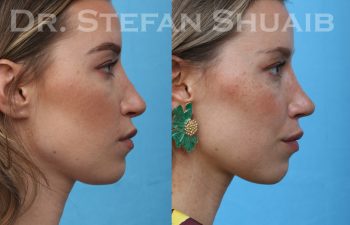 patient before and after rhinoplasty