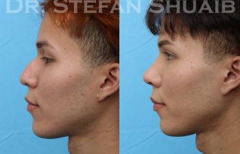patient before and after rhinoplasty