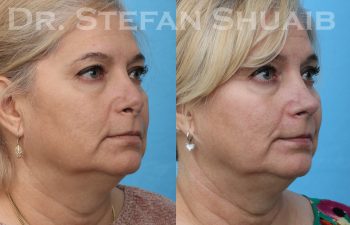 patient before and after revision rhinoplasty