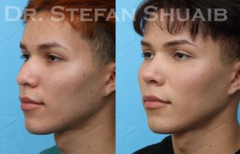 patient before and after rhinoplasty