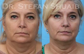 patient before and after revision rhinoplasty