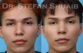 patient before and after rhinoplasty
