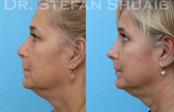 patient before and after revision rhinoplasty