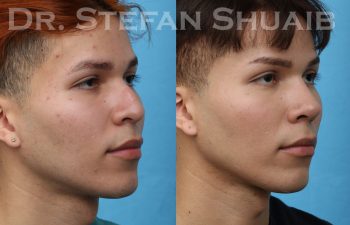 patient before and after rhinoplasty