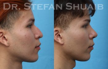 patient before and after rhinoplasty