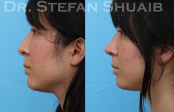 patient before and after rhinoplasty