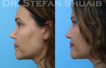 patient before and after revision rhinoplasty