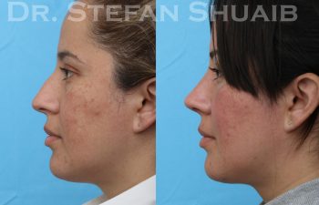 patient before and after rhinoplasty