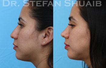 patient before and after rhinoplasty