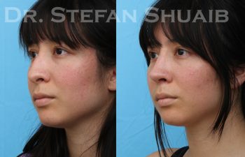 patient before and after rhinoplasty