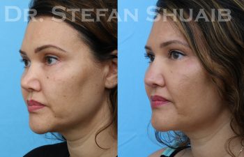 patient before and after revision rhinoplasty