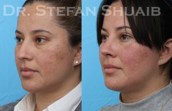 patient before and after rhinoplasty