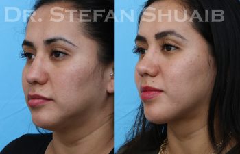patient before and after rhinoplasty