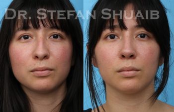 patient before and after rhinoplasty