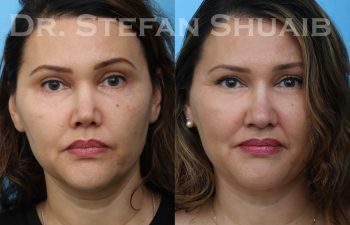 patient before and after revision rhinoplasty