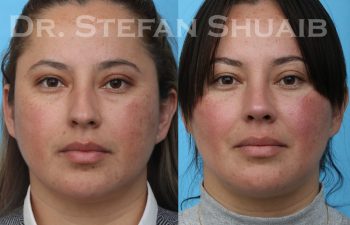 patient before and after rhinoplasty