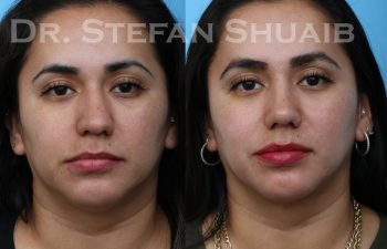 patient before and after rhinoplasty