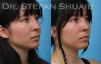 patient before and after rhinoplasty