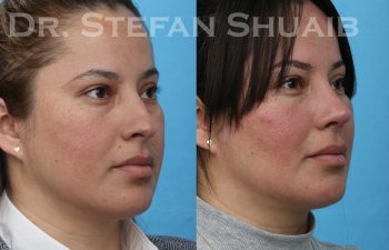 patient before and after rhinoplasty